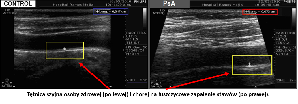 Stan zapalny w autoimmunologicznych chorobach stawów powoduje miażdżycę. Po lewej stronie ultrasonograficzne zdjęcie tętnicy szyjnej zdrowej osoby, po stronie prawej to samo zdjęcie porównywalnej pod względem wieku, BMI i płci osoby z niedawno zdiagnozowanym łuszczycowym zapaleniem stawów (ŁZS). Wyraźnie widać różnice w grubości ściany tętnicy. Osoba zdrowa – 47mm, osoba z ŁZS -73mm. Zwiększona grubość tętnicy wskazuje na miażdżycę. Źródło: Front Immunol. 2018; 9: 139.