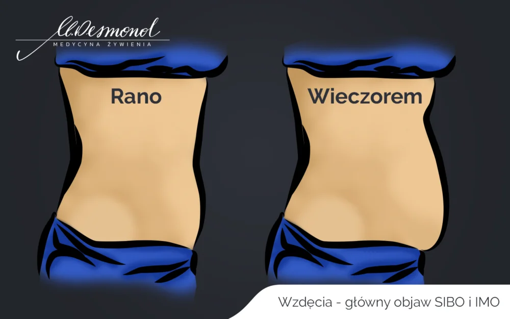 SIBO wzdęcia Główny objaw SIBO - wzdęcia Małgorzata Desmond